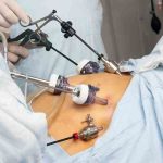 Discover the Many Advantages of Undergoing Gastric Bypass Surgery