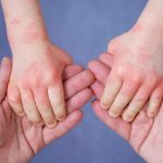Is Eczema Contagious! A Brief Guide About Eczema Contagious