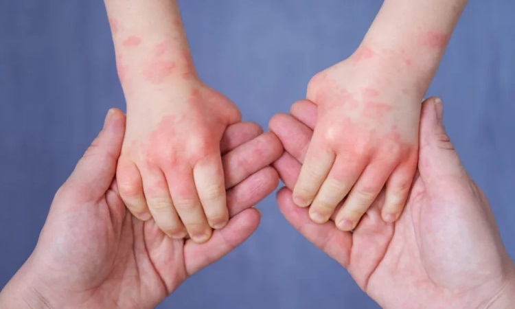 Is Eczema Contagious! A Brief Guide About Eczema Contagious