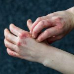 Common Causes of Contact Dermatitis and Their Treatments