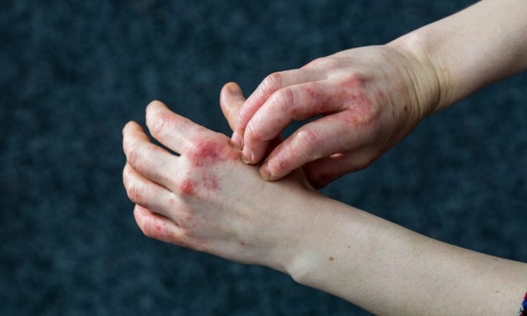 Common Causes of Contact Dermatitis and Their Treatments