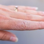 Dyshidrotic Eczema - Everything that You Need To Know!