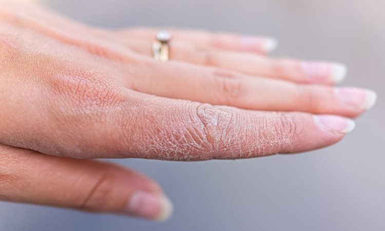 Dyshidrotic Eczema - Everything that You Need To Know!