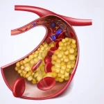 Hyperlipidemia: Understanding the Medical Term for High Cholesterol